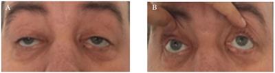 Case report: Clinical profile, molecular genetics, and neuroimaging findings presenting in a patient with Kearns-Sayre syndrome associated with inherited thrombophilia